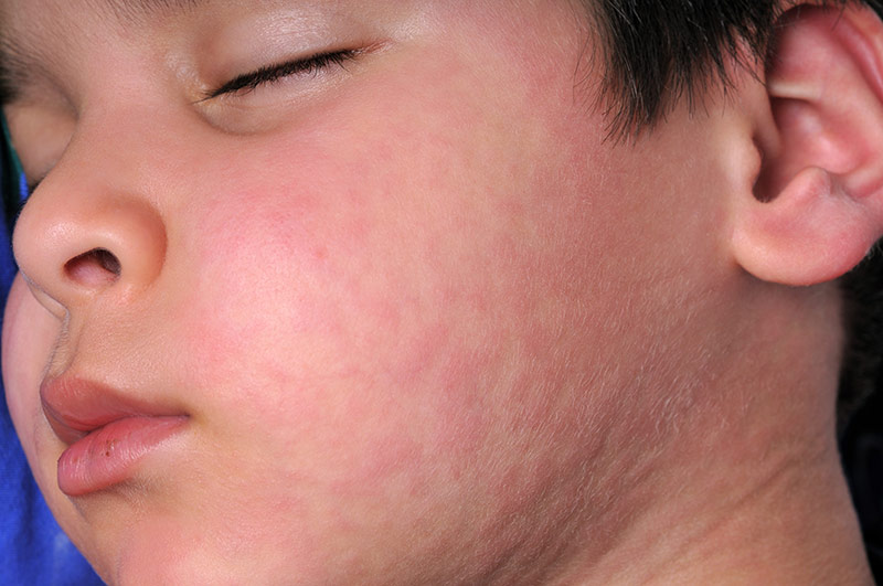 severe hives on face